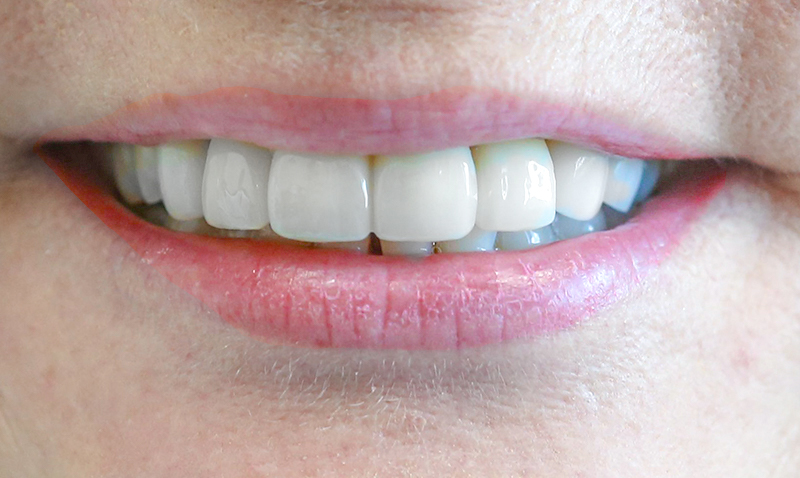 COSMETIC DENTISTRY before and after