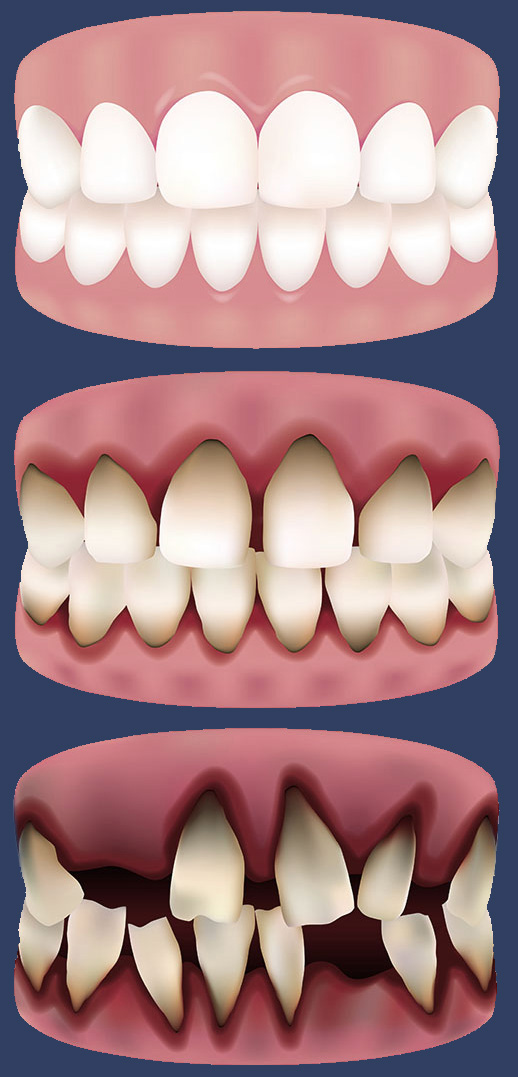 gum disease and tooth loss diagram