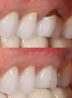 chao pinhole gum graft fix receding gums delray