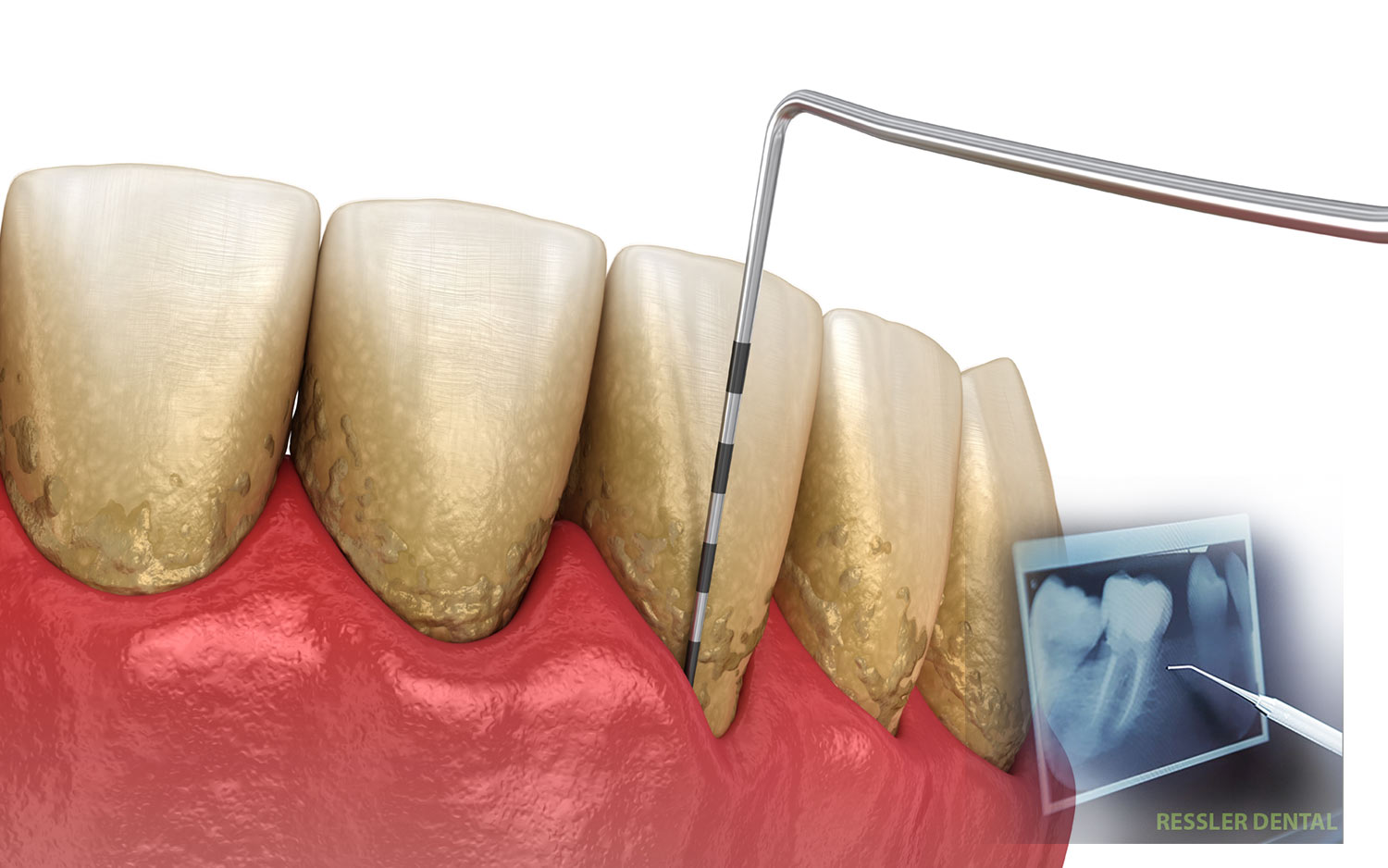 diagnosis for gum disease and periodontal laser therapy