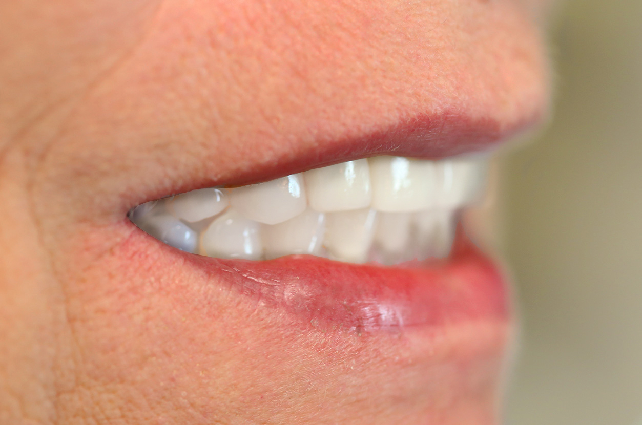 CEREC DENTIST ZIRCONIA before and after