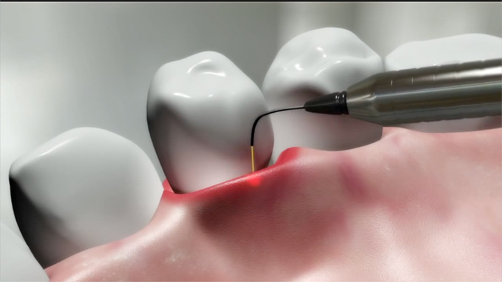laser gum treatment for receding gums