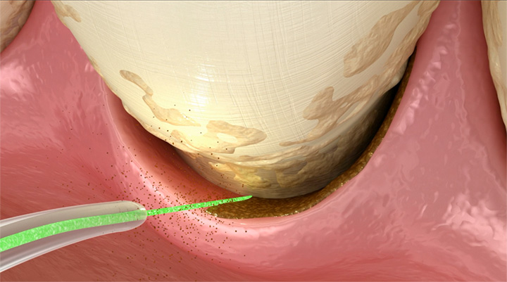 laser gum treatment diagram and technique explanation