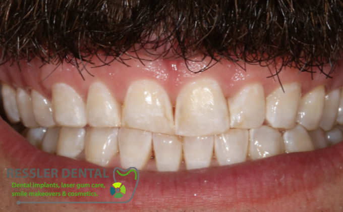 cerec crowns cosmetic dentist before and after