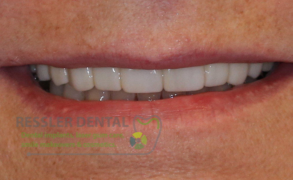 CEREC DENTIST ZIRCONIA before and after