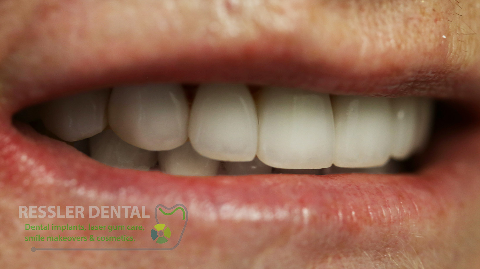 PORCELAIN VENEERS before and after