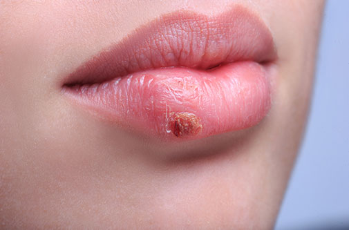 picture of cold sore fever blister oral herpes lesion