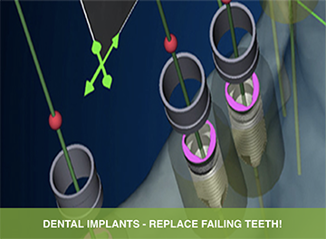 boynton beach dental implant dentist