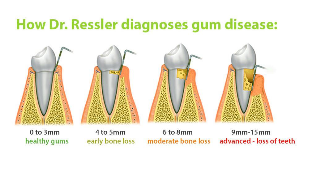 laser gum treatment diagram and technique explanation