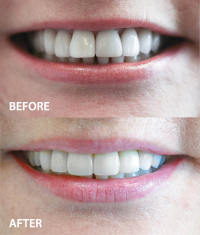 boynton beach cosmetic dentist before and after