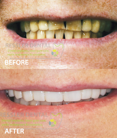 GUM SPECIALIST AND CROWN LENGTHENING DELRAY BEACH