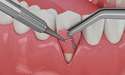 fix receding gums repair