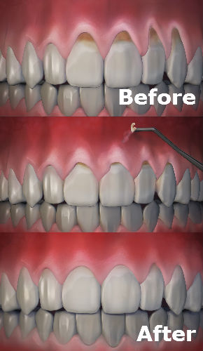 chao pinhole gum graft alternative before and after