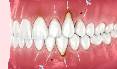 gum graft alternative Chao