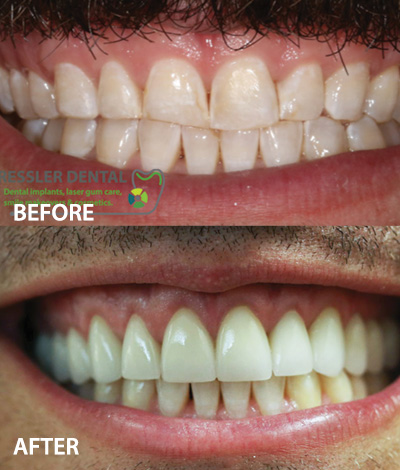 COSMETIC DENTISTRY AND INVISALIGN IN DELRAY