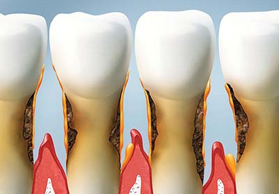 STAGES OF GUM DISEASE