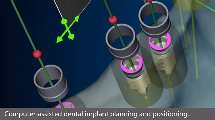 dental implant dentist performs All-on-4